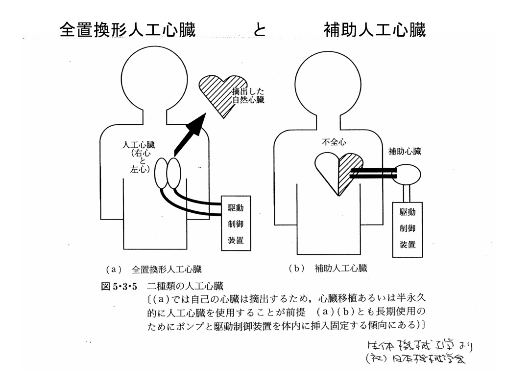 ディア・ファミリー 人工心臓 全置換と補助人工心臓